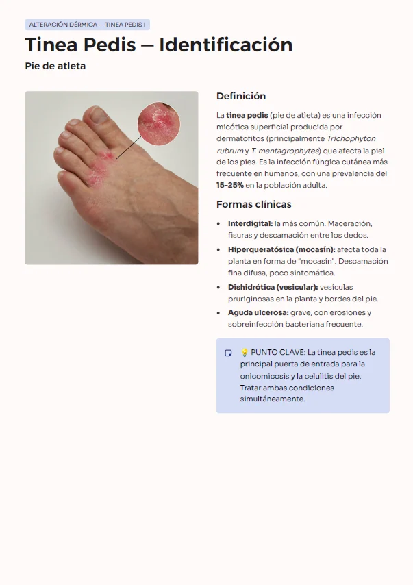Página de la guía: tinea pedis (pie de atleta), con definición, formas clínicas y foto clínica ampliada