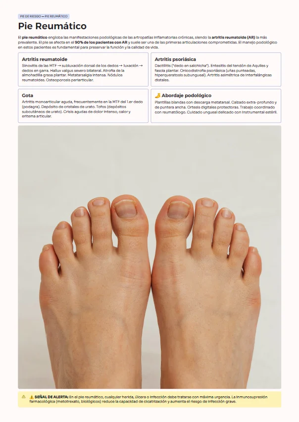 Página de la guía: pie reumático, con artritis reumatoide, artritis psoriásica, gota y abordaje podológico
